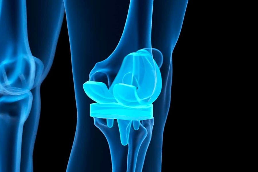 quels sont les inconvenients d une prothese du genou dr thomas stevignon chirurgien orthopediste specialiste genou chirurgie orthopedique paris