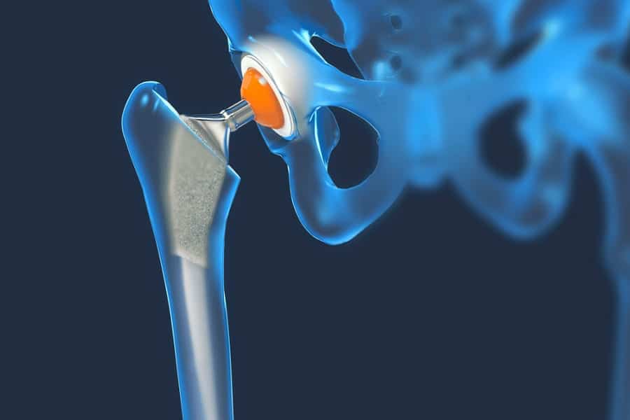 changer la cupule d une prothese de hanche docteur thomas stevignon chirurgien orthopediste specialiste genou chirurgie orthopedique paris
