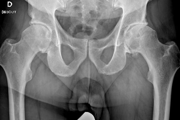 coxarthrose gauche dr thomas stevignon chirurgien orthopediste specialiste pied cheville chirurgie orthopedique paris