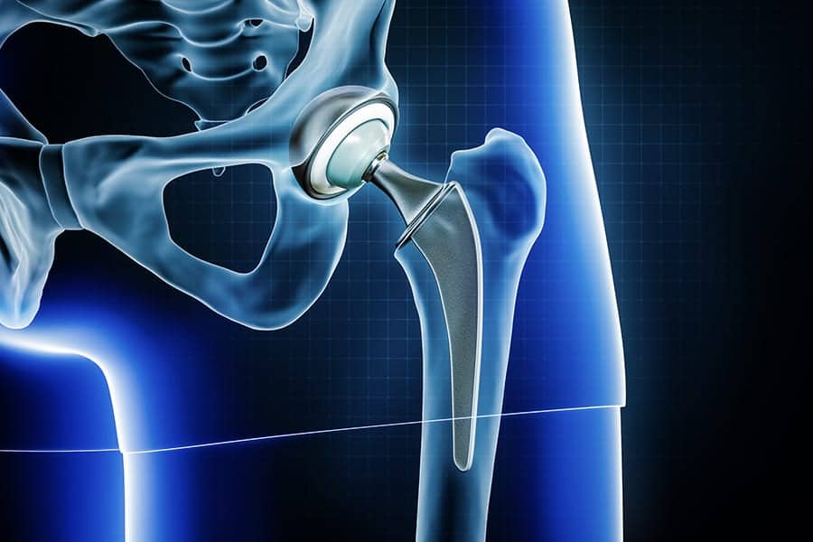 operation prothese de hanche ambulatoire docteur thomas stevignon chirurgien orthopedique paris specialiste