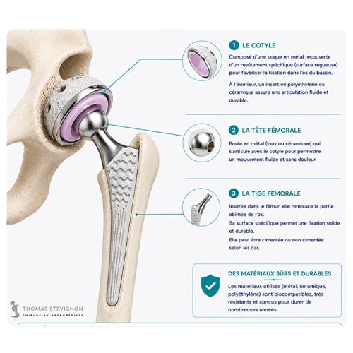 schema prothese de hanche dr thomas stevignon specialiste hanche chirurgien orthopedique paris