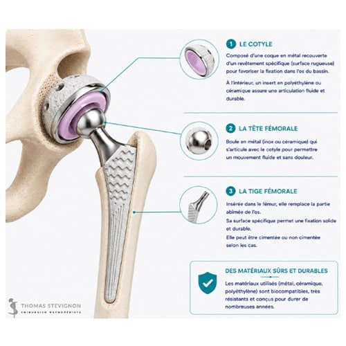 schema prothese de hanche dr thomas stevignon specialiste hanche chirurgien orthopedique paris