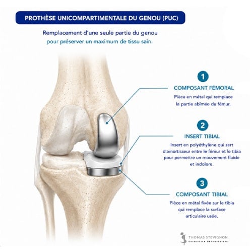 schema prothese unicompartimentale de genou dr thomas stevignon specialiste genou chirurgien orthopedique paris